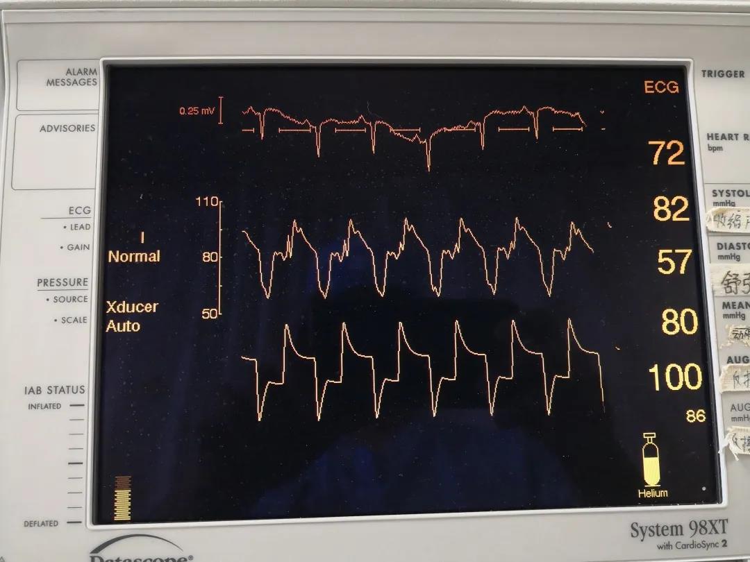 正常值,血管条件差,术后依然持续胸闷,心悸发作,心电监护显示血压偏低