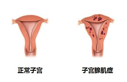 张洪涛肌瘤的剔除剖宫产人流是子宫腺肌症的发病原因之一