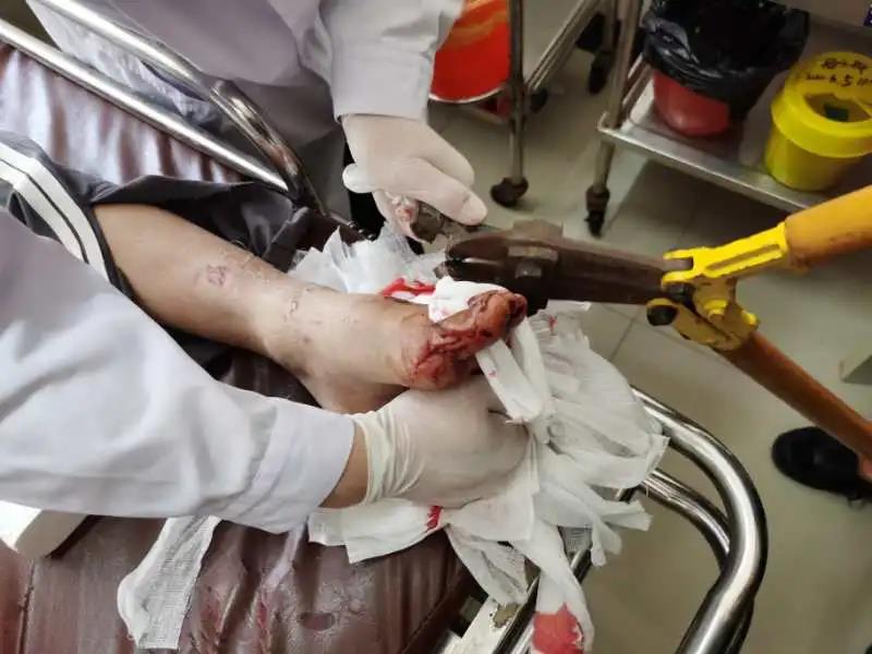 13岁男孩脚掌被钢架刺穿,处置过程中紧咬牙关一声不吭!