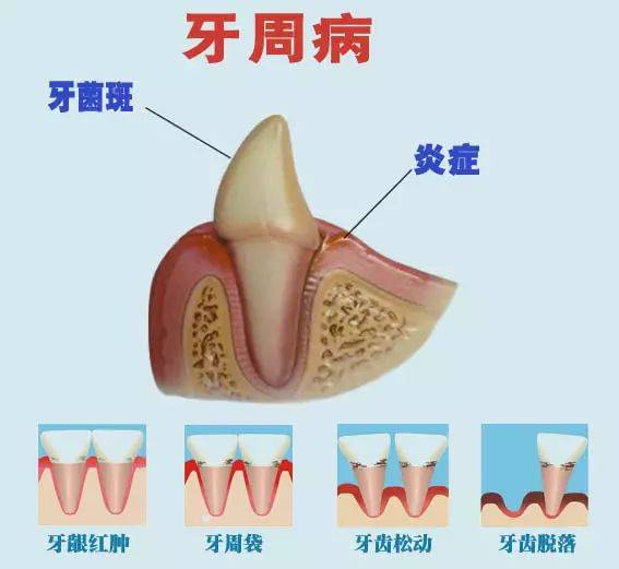根面龋牙龈萎缩,牙周炎等疾病导致牙根暴露,食物嵌塞,加上细菌作用可