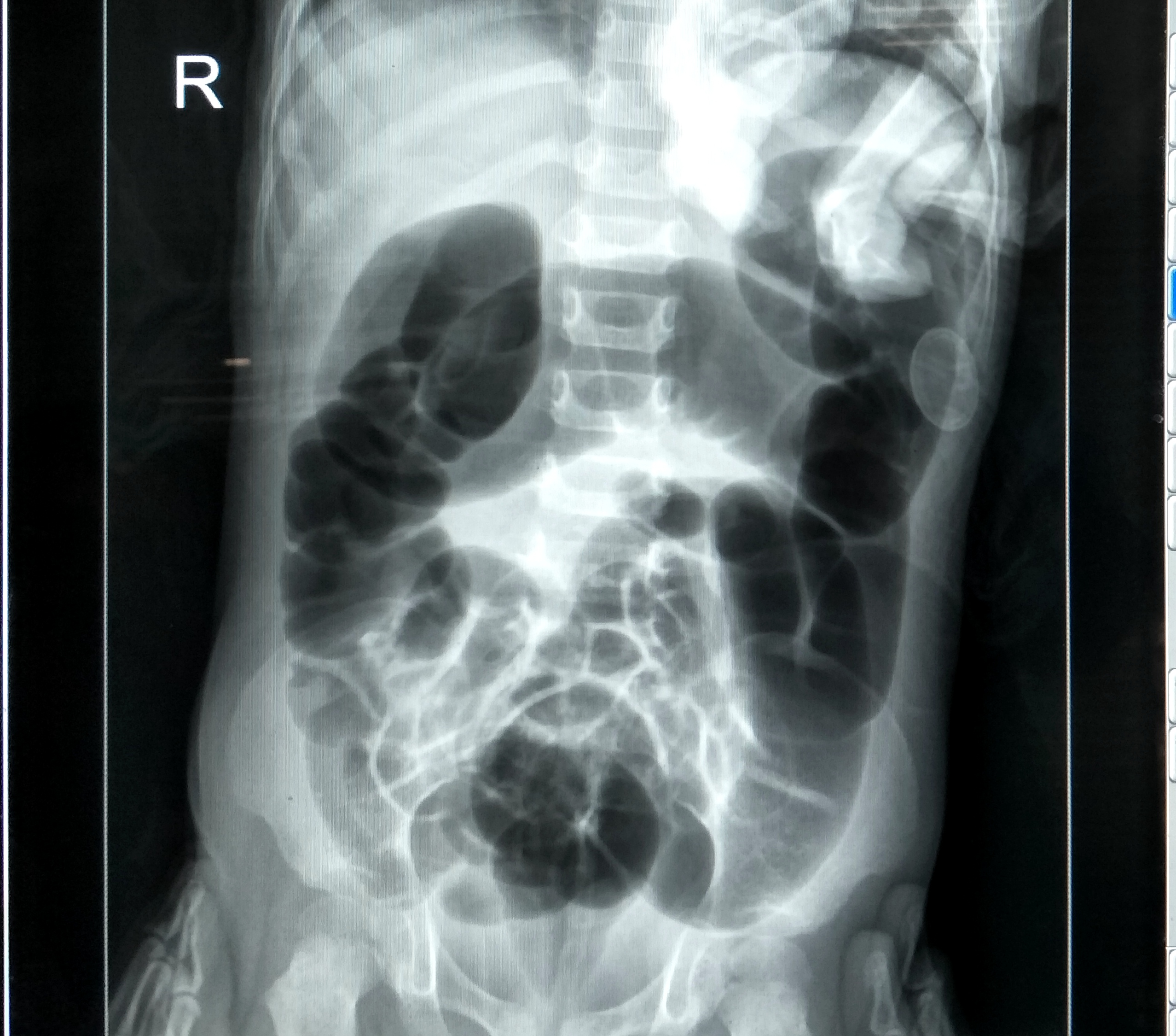 罕见漯河2岁幼童三处肠套叠医院连做3次空气灌肠整复术