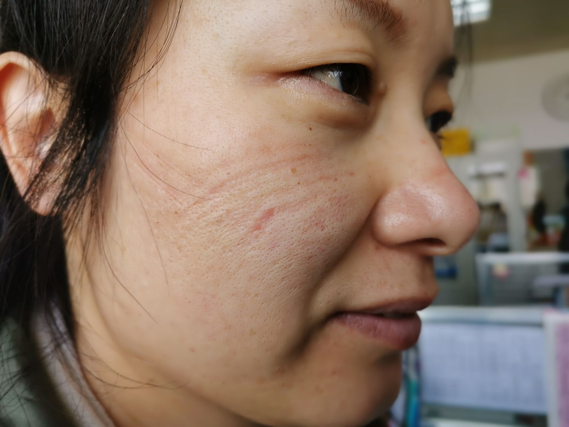 周口感染控制专家段雪亚口罩勒痕是最美的脸妆