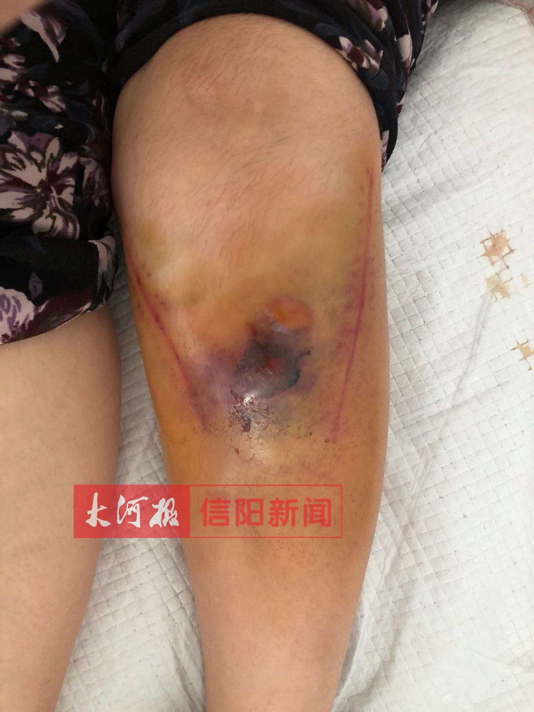 |信阳一医院病患做康复时发生意外，回应：建议病人先转院进行治疗