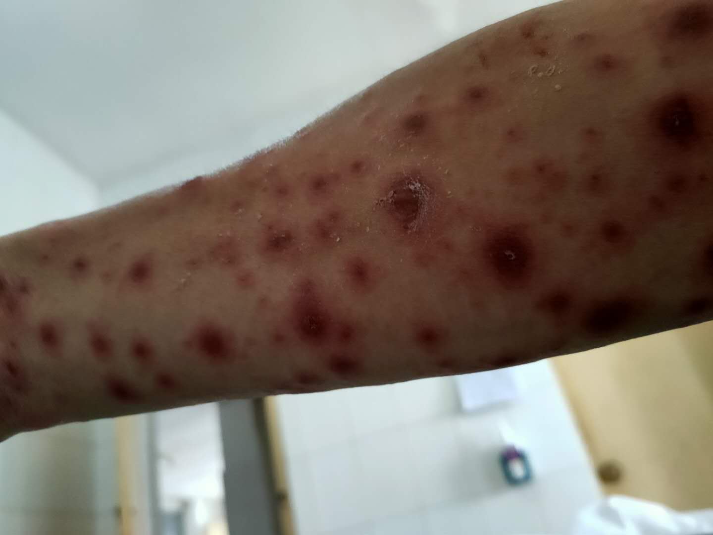 |诊治6天却满身红疹，固始县人民医院被指工作失职