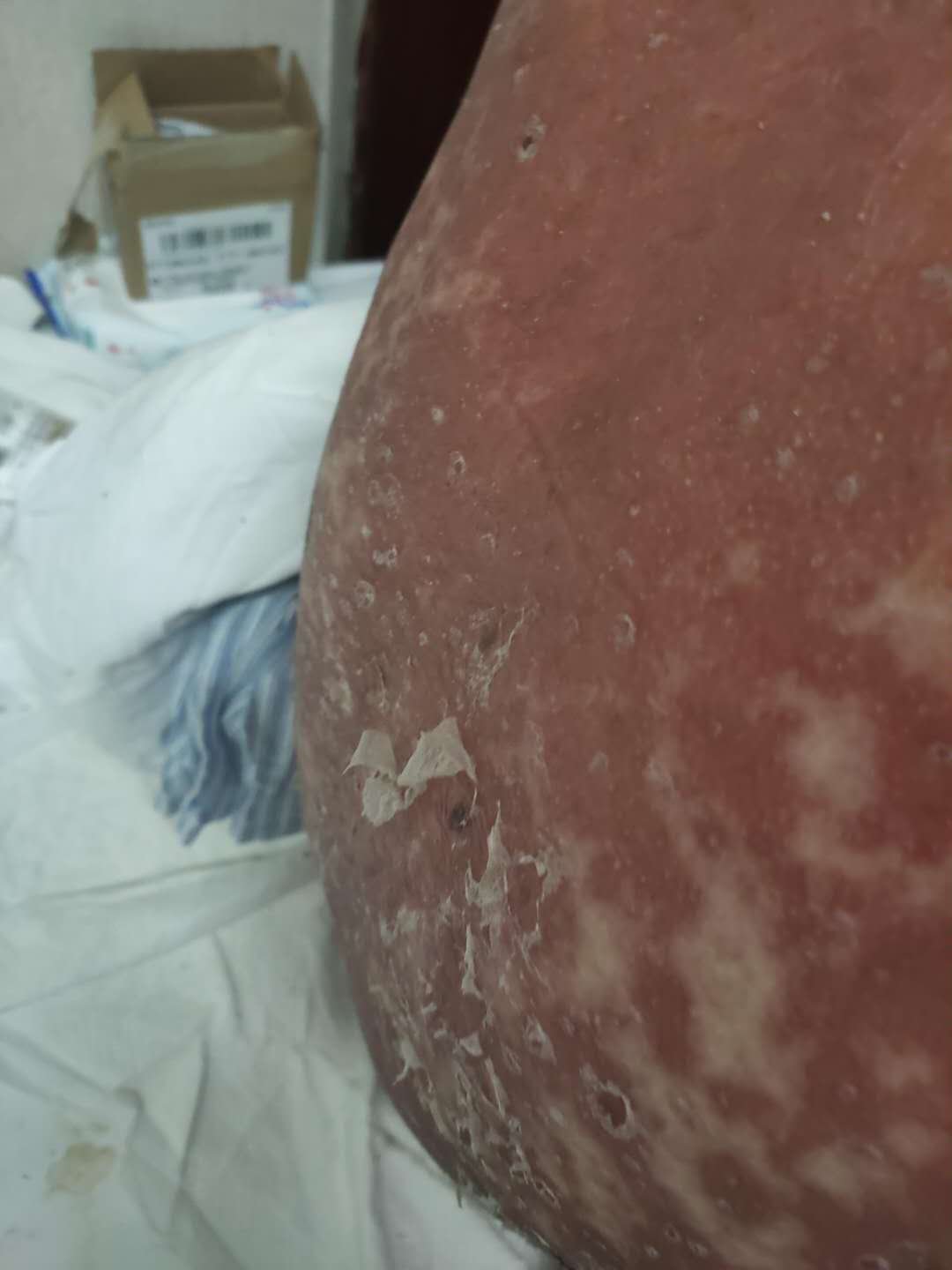 |诊治6天却满身红疹，固始县人民医院被指工作失职