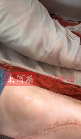 |信阳一医院病患做康复时发生意外，回应：建议病人先转院进行治疗